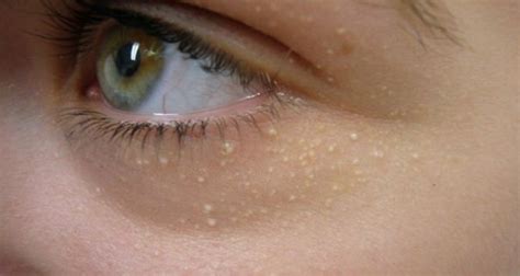 Do You Have White Skin Dots Under Your Eyes Heres How To Get Rid Of