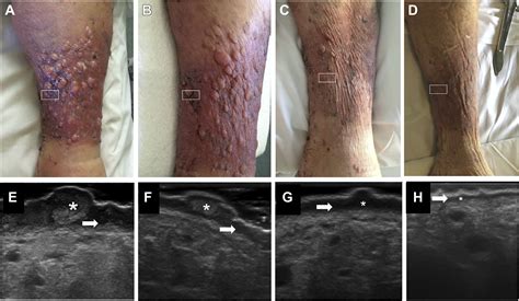 Ultrasound Of Verrucous Hyperplasia Of The Skin Related To Venous