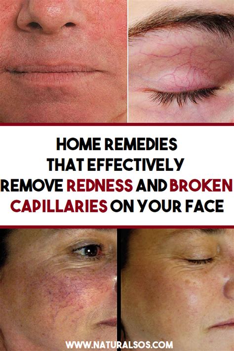 Home Remedies That Effectively Remove Redness And Broken Capillaries On