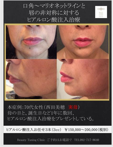 70代女性へのヒアルロン酸注入治療（口角、マリオネット、唇） Beauty Tuning Clinic