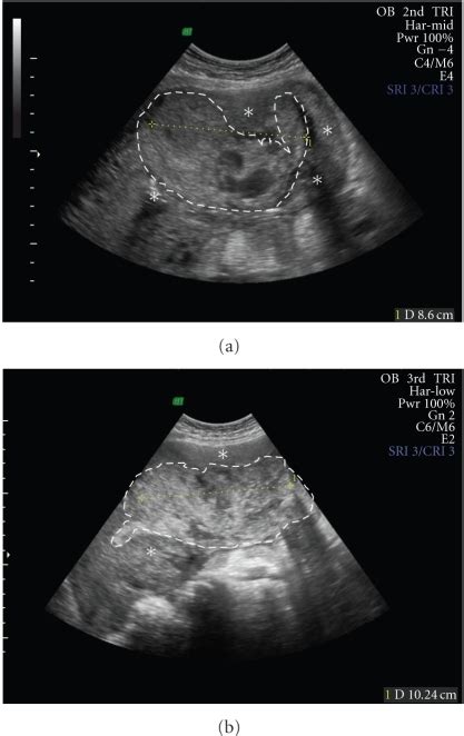 Transabdominal Ultrasound Image Taken On Postpartum Day Open I
