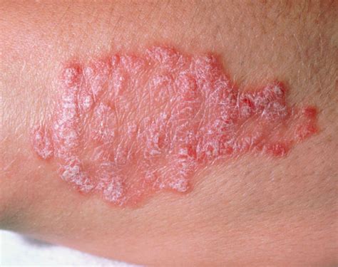 Psoriasis Cures These Three Treatments May Alleviate Symptoms Life
