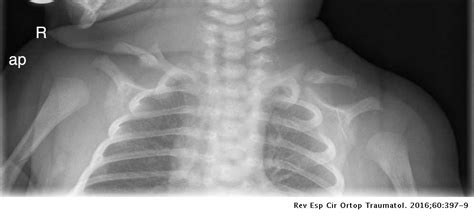 Bilateral Congenital Seudarthrosis Of The Clavicle A Clinical Case