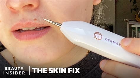 Heated Needle Tool Claims To Remove Skin Tags And Moles At Home The