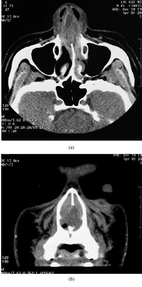Figure From Spontaneous Nasal Septal Abscess Presenting As Complete Nasal Obstruction