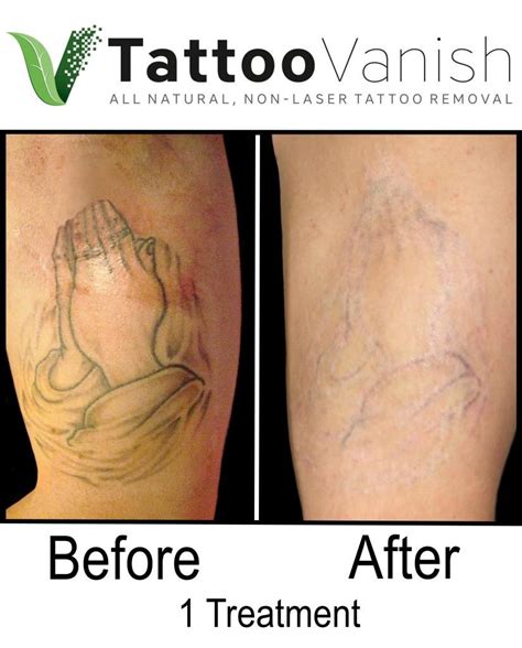 Top 123 Tattoo Removal Before And After Photos