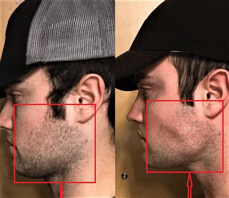 Best Jaw Exercises Do Jawline Exercises Actually Work