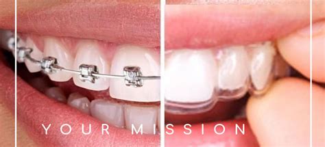 Invisalign Vs Braces Comfortho Invisalign Ortho