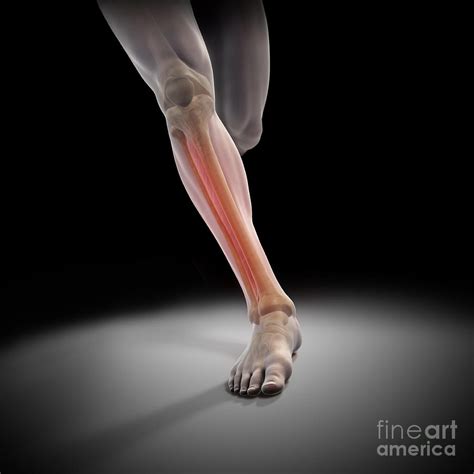 Medial Tibial Stress Syndrome Photograph By Science Picture Co