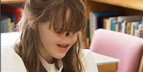 Girl Born Without Eyes And Nose Bubblews Girl Eyes Nose