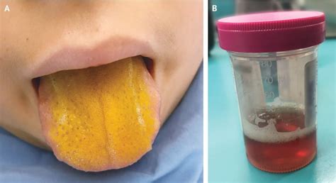 Boys Bright Yellow Tongue Was A Sign Of Rare Disorder Live Science