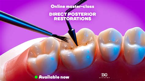 Direct Posterior Restorations Simplifying Occlusal Surface And Bonding