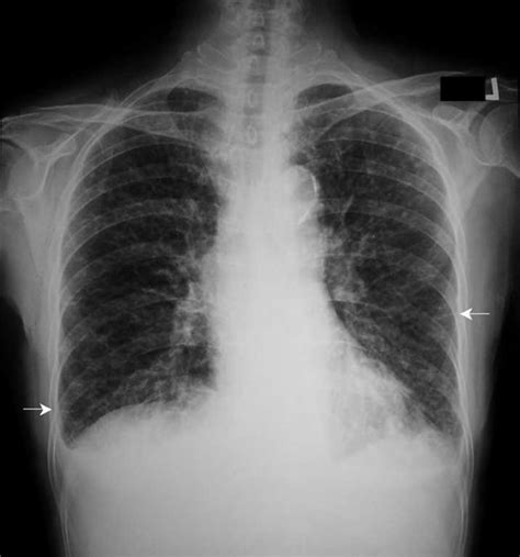 Classically kerley b lines are seen with cardiogenic pulmonary edema, where left ventricular failure causes increased… frontal radiograph of the chest demonstrates marked interlobular septal thickening with septal lines (kerley b lines) and reticular opacities in the lung periphery. Chest radiograph showing diffuse interstitial pulmonary ...