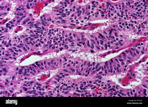 Typical Carcinoid Tumor Of The Lung Trabecular Pattern Stock Photo Alamy