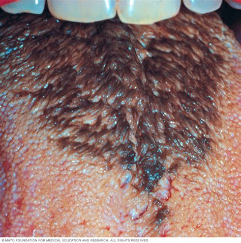 Black hairy tongue Disease Reference Guide - Drugs.com
