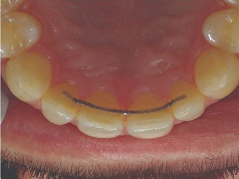 Direct Esthetic Restoration The Case Of The Lingual Wire Morning Huddle