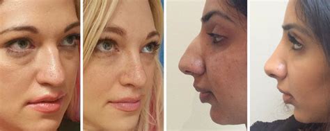 Rhinoplasty Before And After Uk Wide Nose Bulbous Rounded Nasal Tip