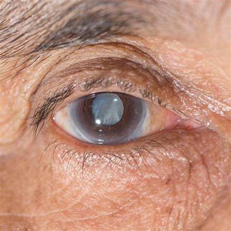 Cataract symptoms cataracts currently affect over 22 million americans who are 40 or older, and as the population. Cataract: oorzaak, symptomen en behandeling - OgenBlik