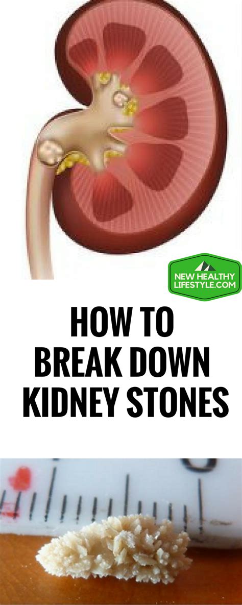 How To Break Down Kidney Stones And Kill Bladder Infection With This