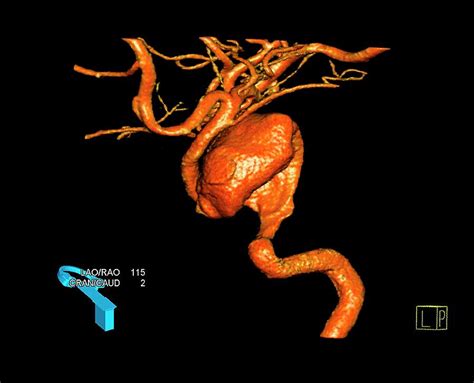 Aneurysm In Neck Artery Photograph By Zephyrscience Photo Library