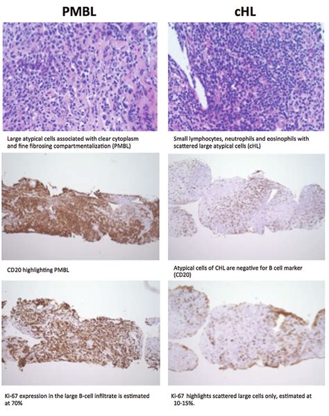 Pathological Comparison Of Pmbcl And Hodgkin Lymphoma On Biopsy