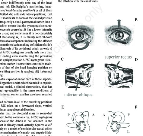 Paroxysmal Positional Nystagmus Due To Unilateral Right Posterior