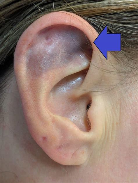 Ear Teachmepaediatrics