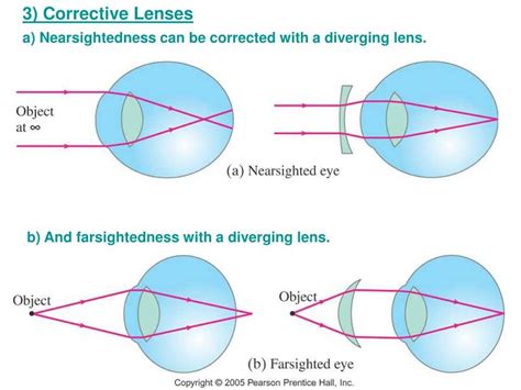 The Complete Guide To Understanding Nearsightedness Exploring The