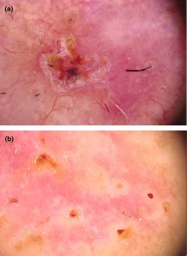 Dermoscopy Of Basal Cell Carcinoma Wozniak‐rito 2018 Clinical And
