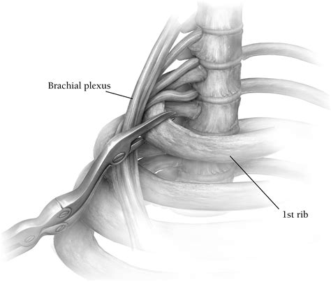 Supraclavicular Approach To First Rib Resection For Thoracic Outlet