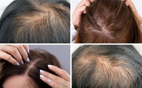 Поредение волос Cosmedica Clinic Dr Levent Acar