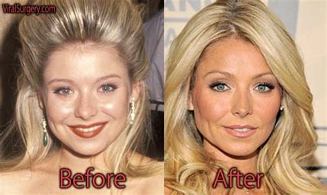 Kelly Ripa Plastic Surgery Before And After Botox Pictures