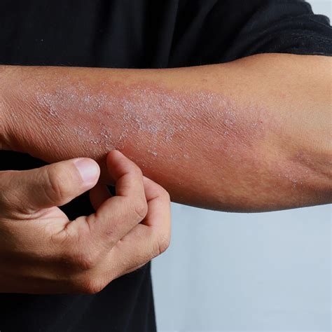 Dermatite At Pica O Que Causas Sintomas E Pomadas Eurekka The Hot Sex