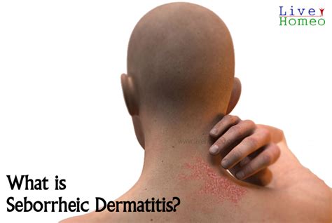 Seborrheic Dermatitis Treatment Causes Symptoms Risk Factors Zohal