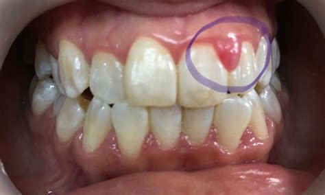 Gum Swelling Shenton Dental Surgery
