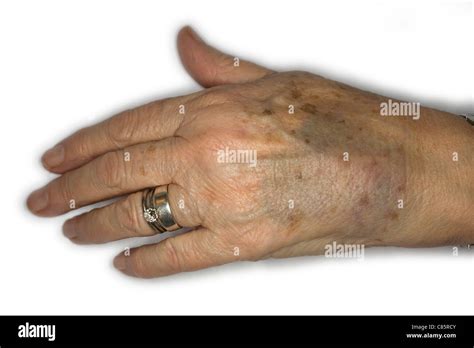 Bruised Skin Hi Res Stock Photography And Images Alamy