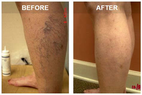 Spider Veins And Varicose Veins Whats The Difference Vein