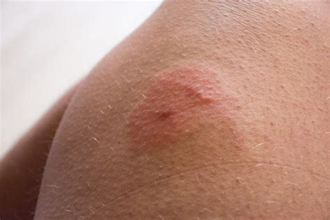 How To Treat Common Stings