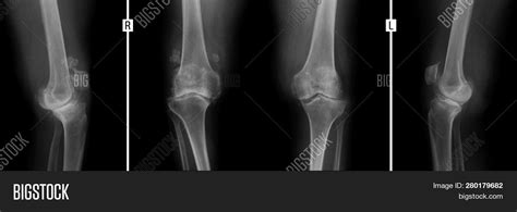 X Ray Knee Joints Image And Photo Free Trial Bigstock