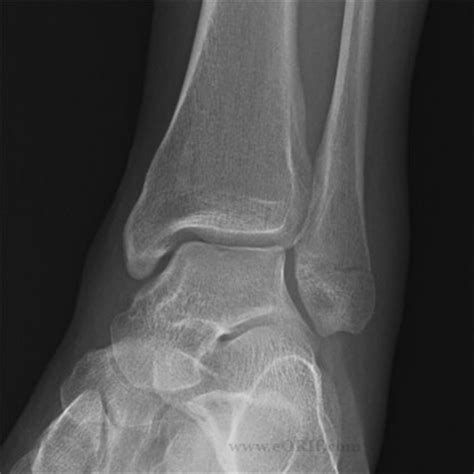 Lateral Malleolus Fracture Cases Eorif My Xxx Hot Girl