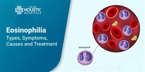Eosinophilia Types Causes Symptoms Diagnosis And Treatment
