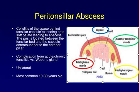 Peritonsillar Abscess Anatomy
