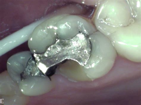 Fibre Reinforced Composite Filling Used To Restore A Fractured Tooth