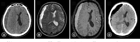Figure 1 From A Rare Case Of Hypertrophic Pachymeningitis After Surgery