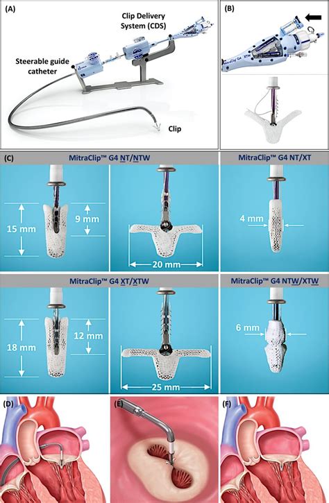 Transcatheter Mitral Valve Repair An Overview Of Current And Future