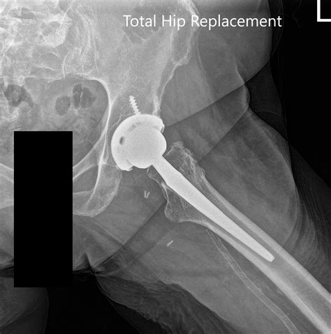 Case Study Left Hip Total Replacement In 82 Year Old Male