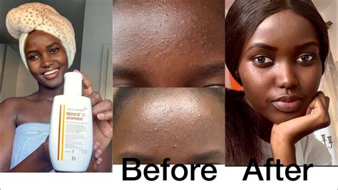 How I Cleared My Acne In 10 Days Tiny Bumps On Forehead Fungal