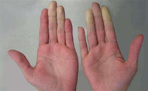Finger Numbness Numb Fingers Left Hand Numb Fingers Right Hand