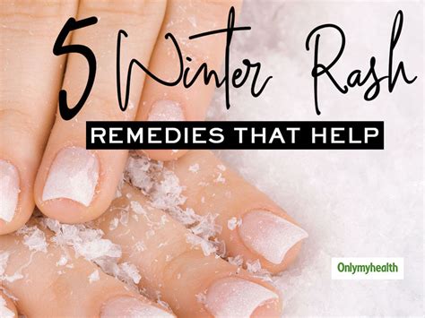 View 21 Dry Skin Rash Winter Eczema On Hands Suddenlyinfopics