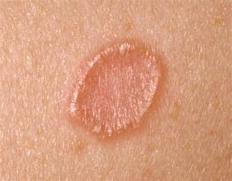 👉 Granuloma Annulare Pictures Causes Contagious Symptoms
